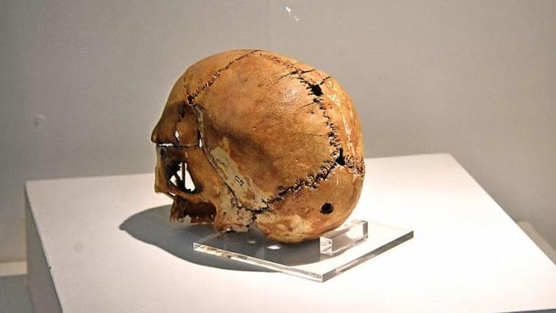 Scalpello, pietra e sopravvivenza: la scioccante realtà della chirurgia cerebrale dell'antico Egitto