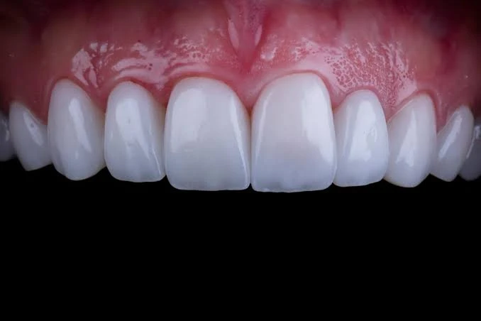 8 Veneers Program & Tours in Cairo