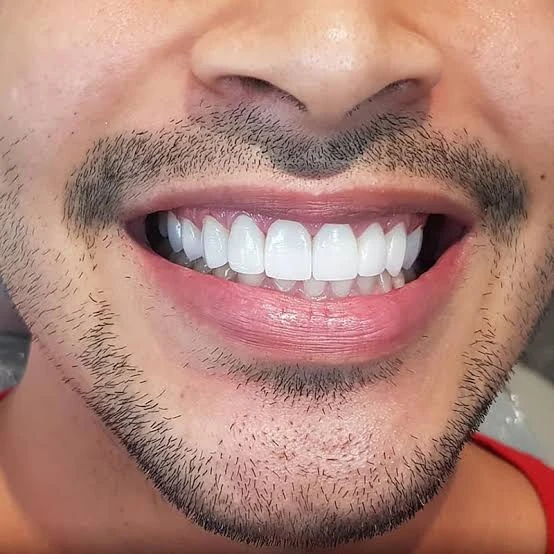 All-on-6 Dental Implant with fixed zirconia teeth & Cairo Attraction Tour