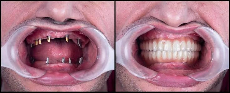 Best Price Package 8 Veneers Program in Cairo