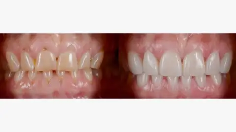 All-on-4 Dental Implants & Visiting Step Pyramid of Djoser