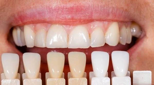 The Ultimate Guide to Teeth Whitening with Day Tour in Alexandria