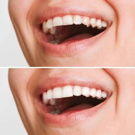 The Ultimate Guide to Teeth Whitening with Day Tour in Alexandria