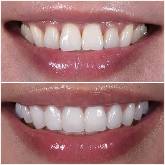 The Ultimate Guide to Teeth Whitening with a Day Tour In Old Cairo