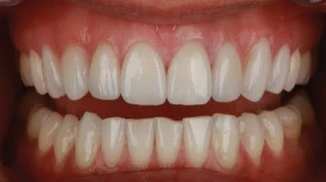 Dental Implants with a Day Tour In Alexandria