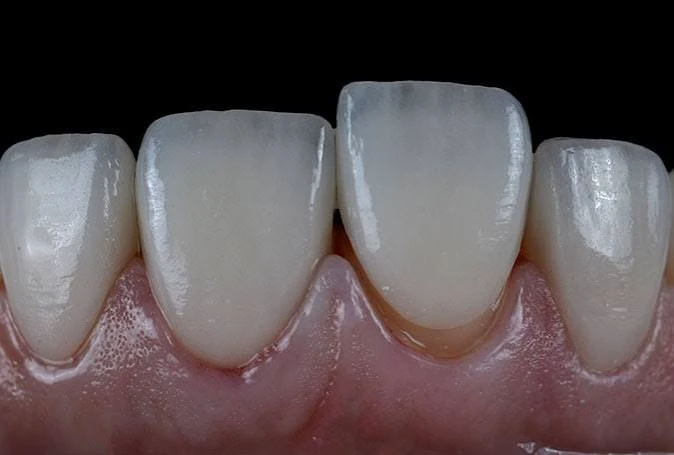 8 Veneers Program & Day Tour to the Hanging Church