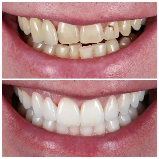 8 Veneers Program & Day Tour to the Hanging Church