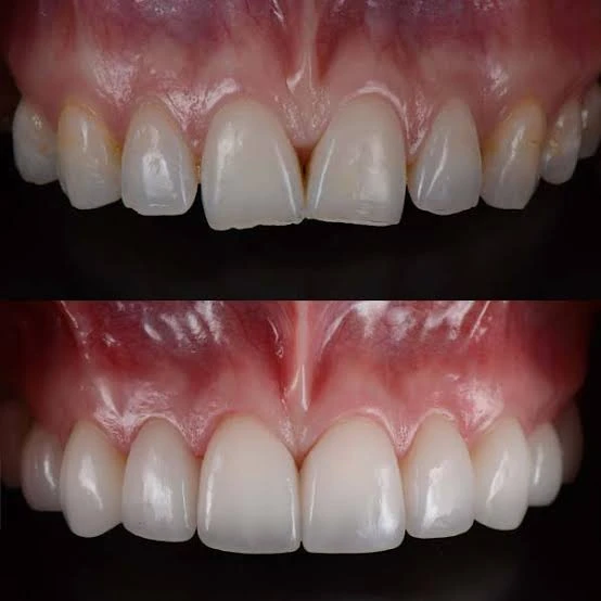 Best Price Package 8 Veneers Program with Day Tour to the Hanging Church
