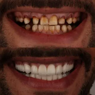 8 Veneers Program & Sharm el-Sheikh Getaway