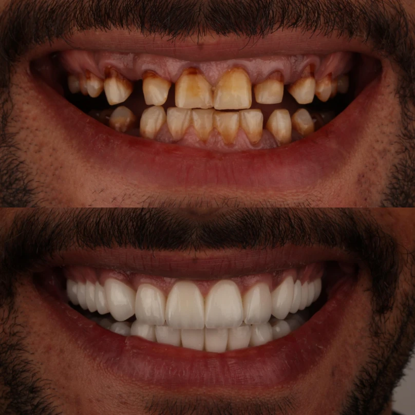 8 Veneers Program & Sharm el-Sheikh Getaway